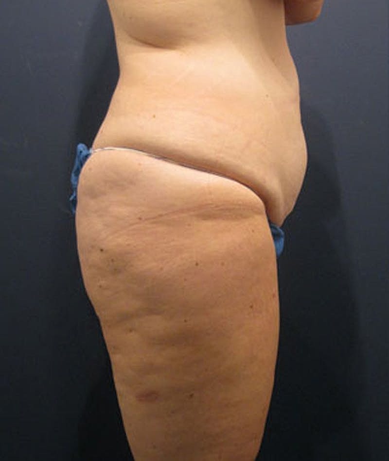 Buttock Fat Transfer Before & After