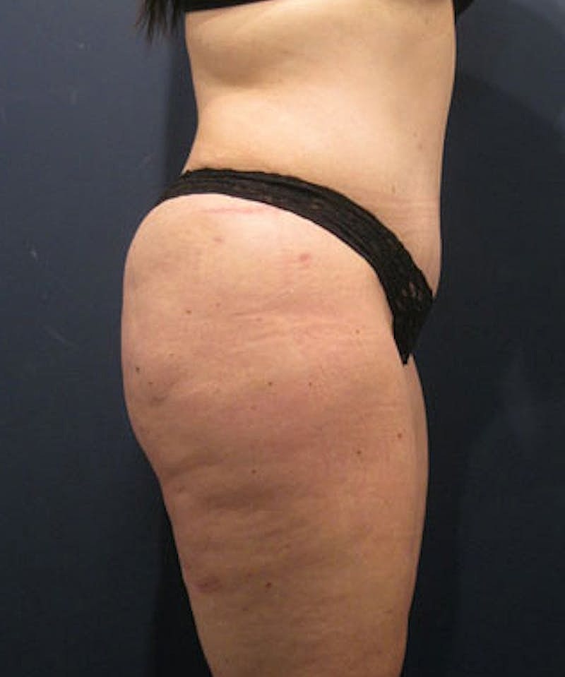 Buttock Fat Transfer Before & After