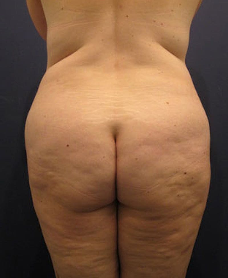 Buttock Fat Transfer Before & After