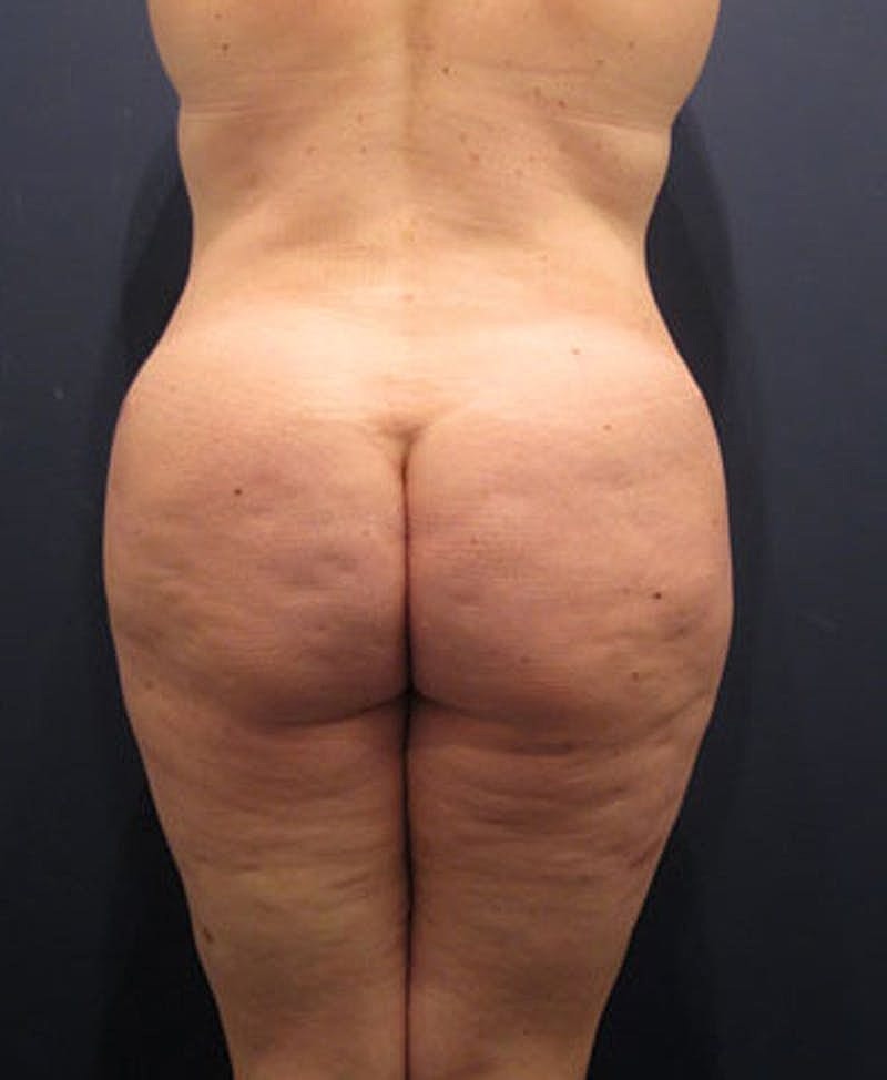 Buttock Fat Transfer Before & After
