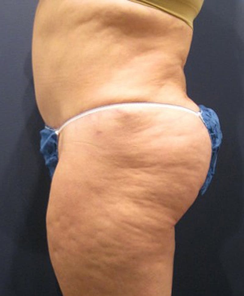 Buttock Fat Transfer Before & After
