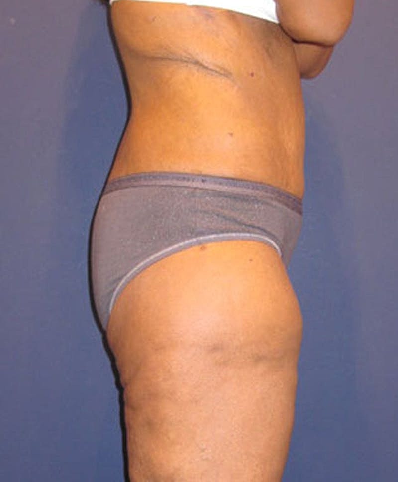 Buttock Fat Transfer Before & After