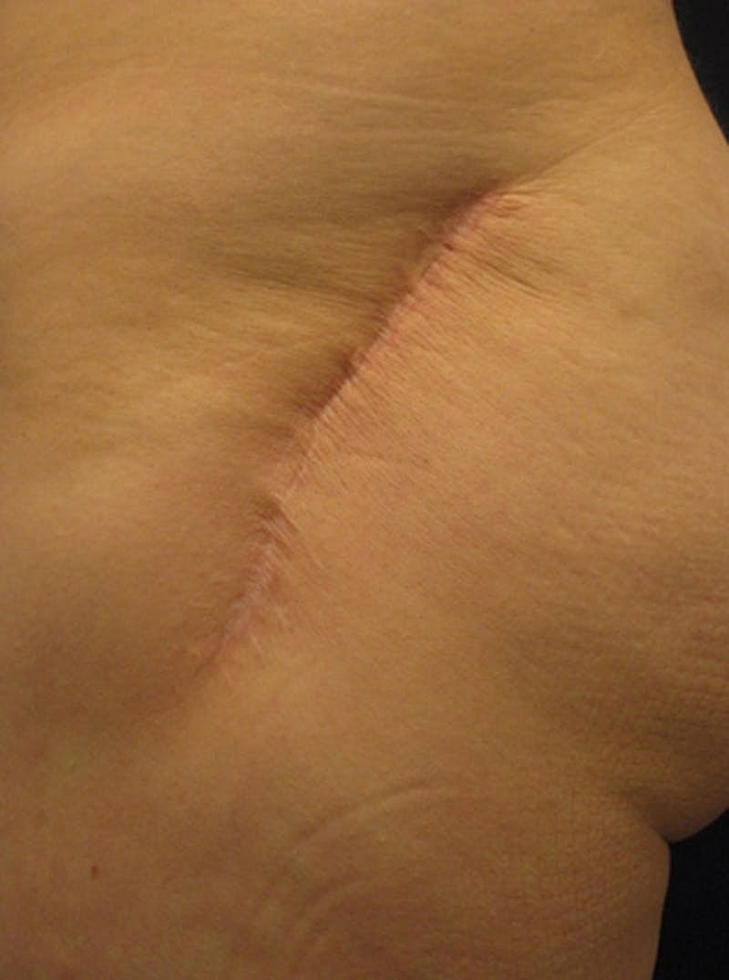 Buttock Fat Transfer Before & After