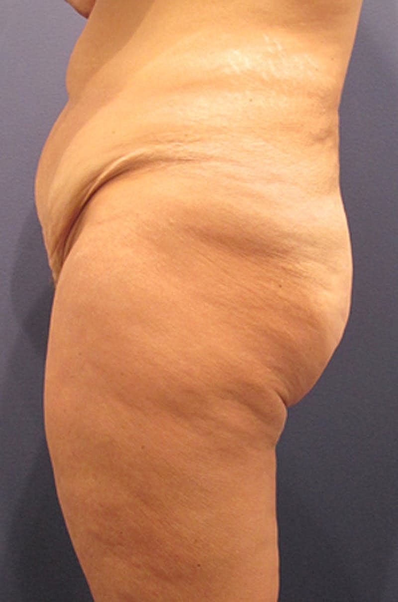 Buttock Fat Transfer Before & After