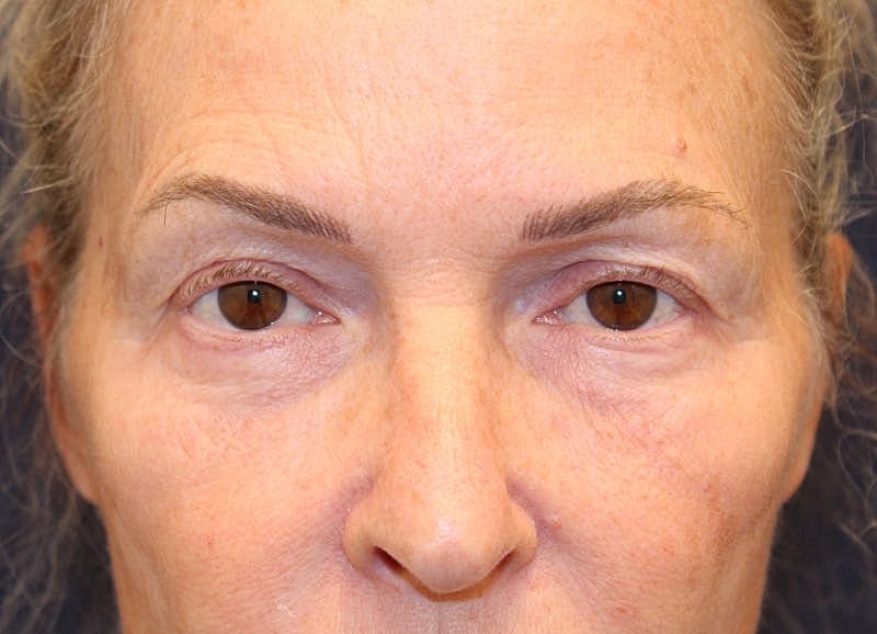 Blephroplasty Before & After