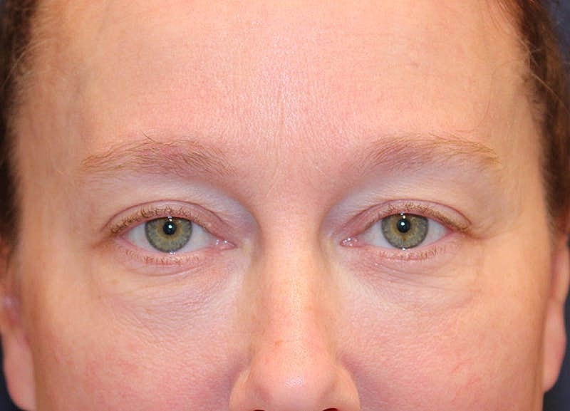 Blephroplasty Before & After