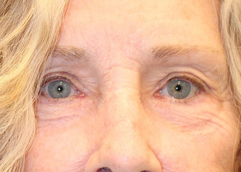 Blephroplasty Before & After