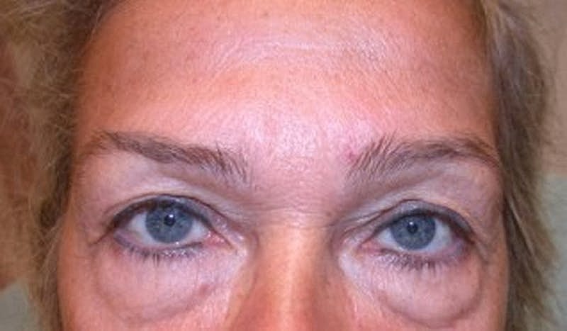 Blephroplasty Before & After