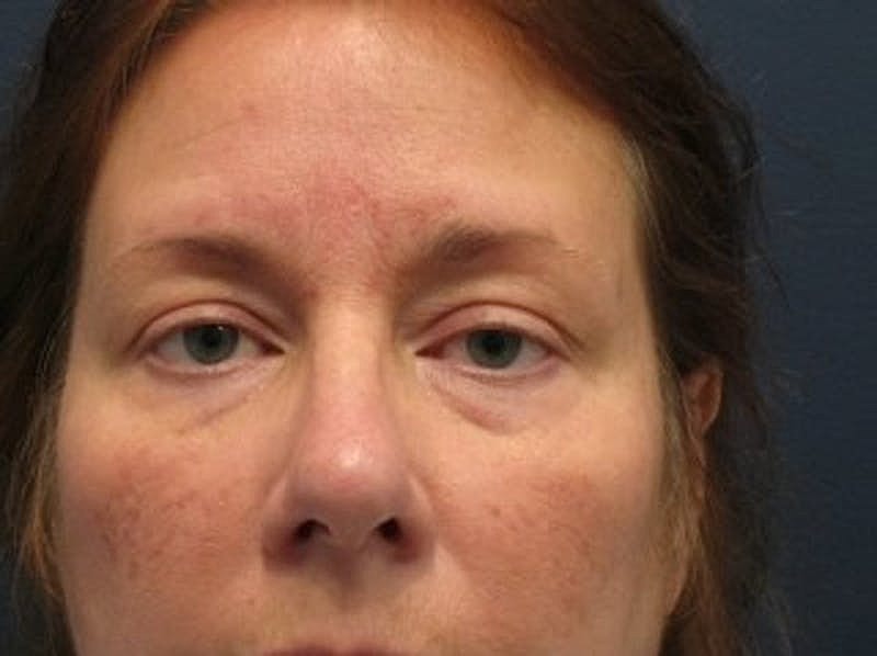 Blephroplasty Before & After