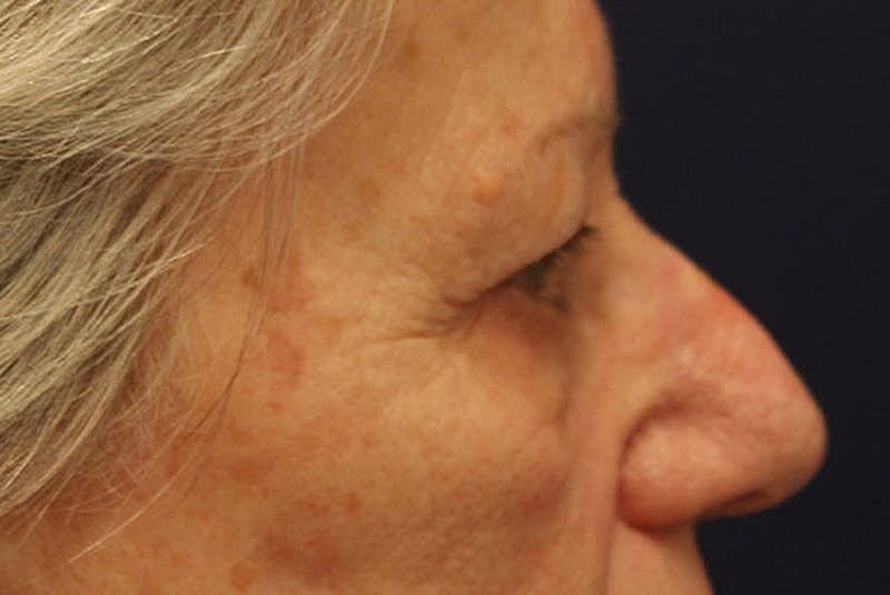 Blephroplasty Before & After