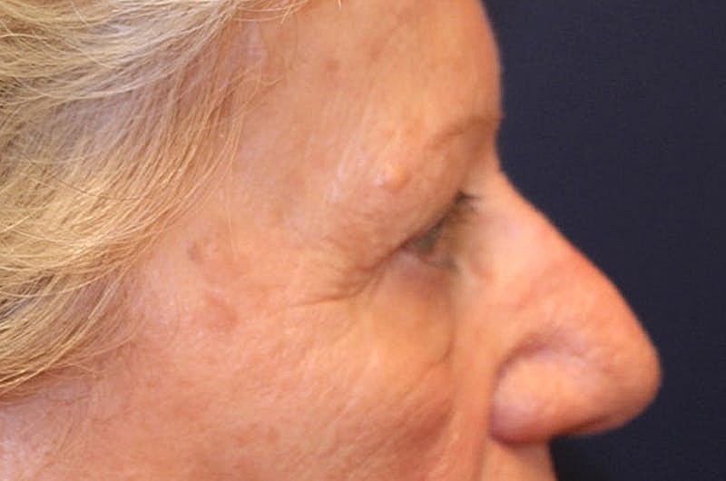 Blephroplasty Before & After