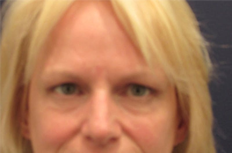 Blephroplasty Before & After