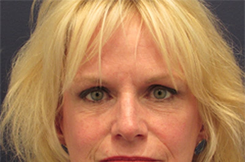 Blephroplasty Before & After