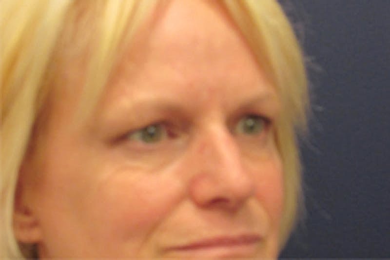 Blephroplasty Before & After