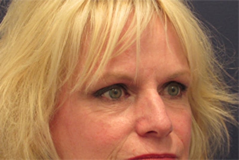 Blephroplasty Before & After