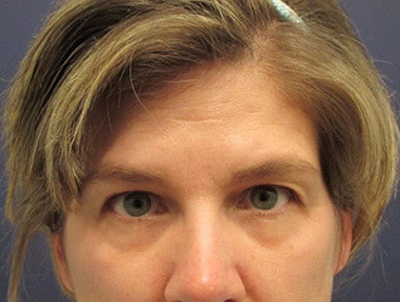 Blephroplasty Before & After