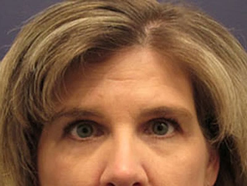 Blephroplasty Before & After