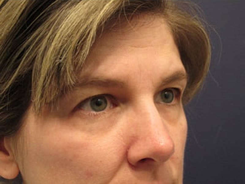 Blephroplasty Before & After