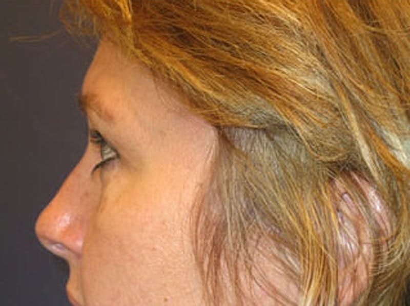 Blephroplasty Before & After