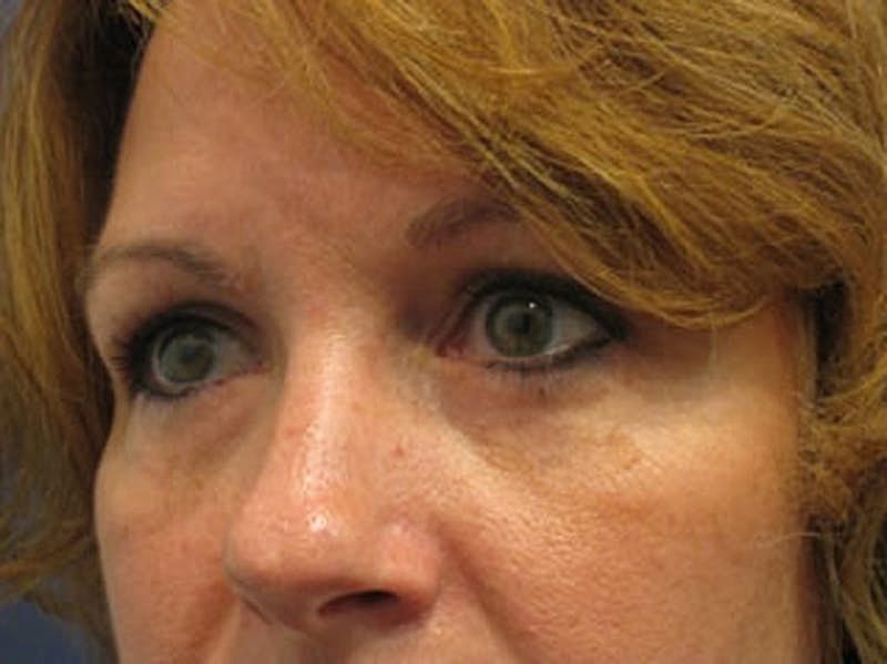 Blephroplasty Before & After