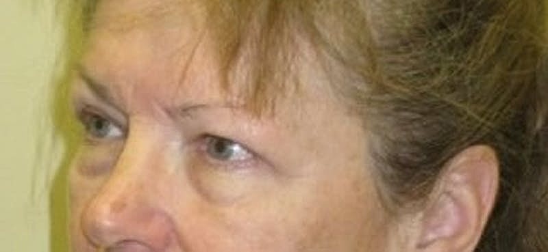 Blephroplasty Before & After