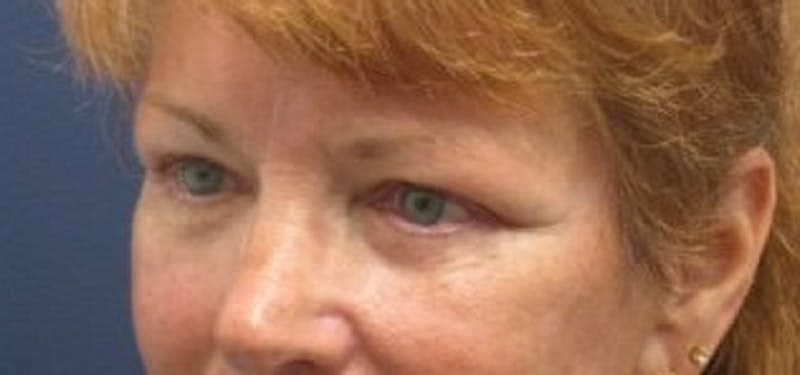 Blephroplasty Before & After