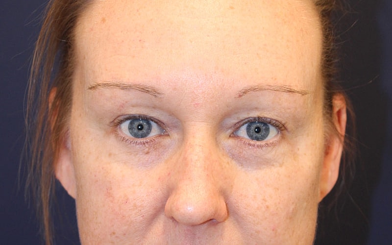 Blephroplasty Gallery Before & After