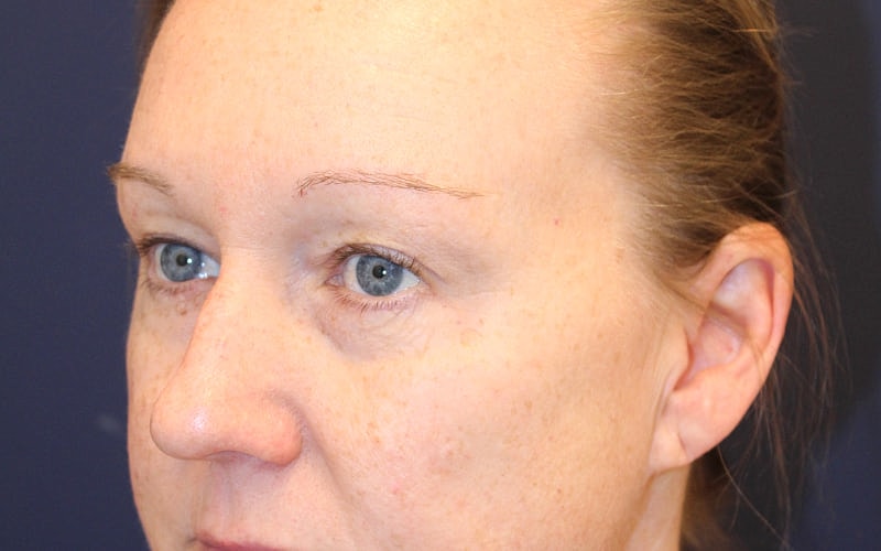 Blephroplasty Gallery Before & After