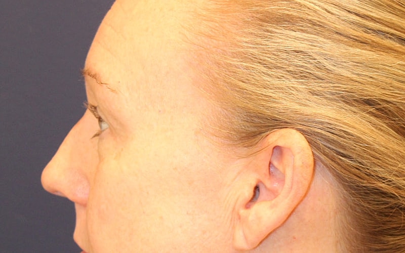 Blephroplasty Gallery Before & After