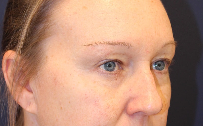 Blephroplasty Gallery Before & After