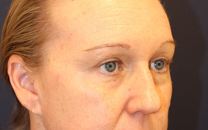 Blephroplasty Gallery Before & After