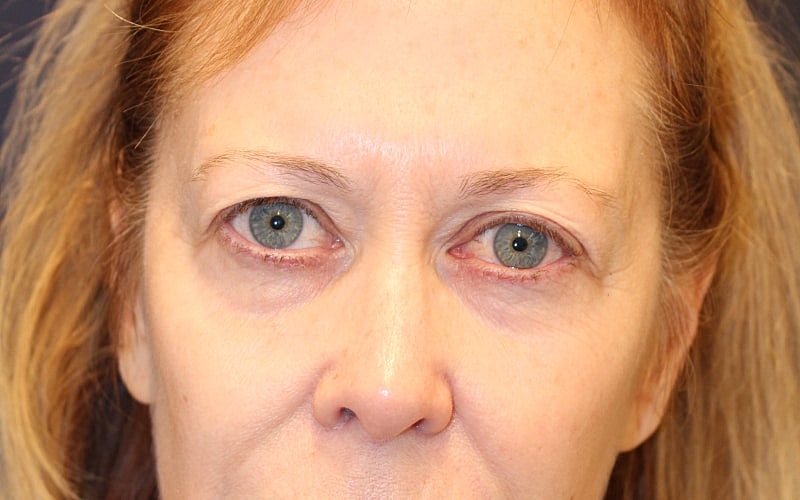 Blephroplasty Gallery Before & After