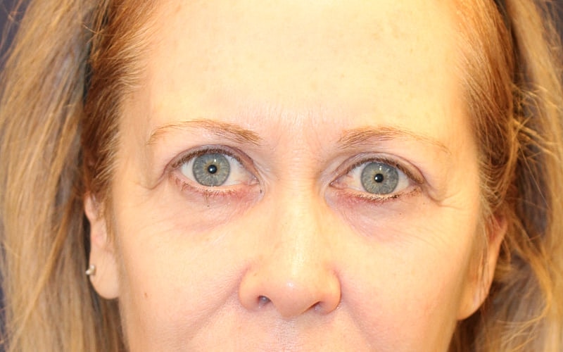 Blephroplasty Gallery Before & After