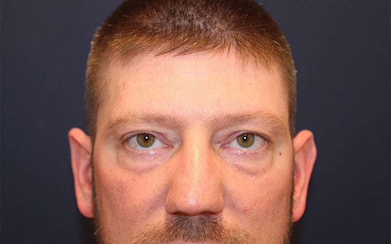 Blephroplasty Gallery Before & After
