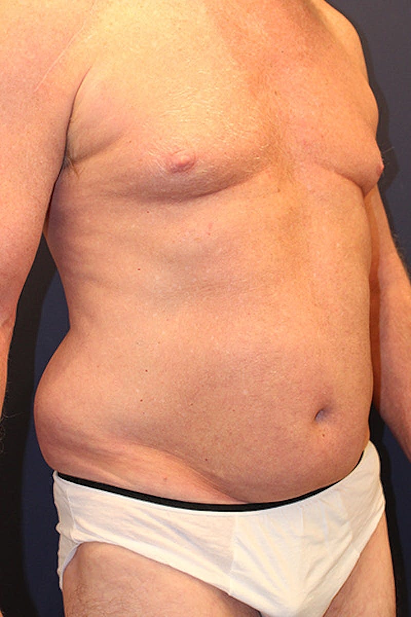 Liposuction Before & After