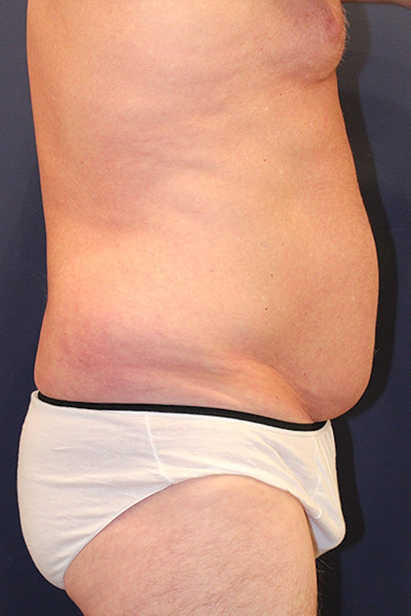Liposuction Before & After