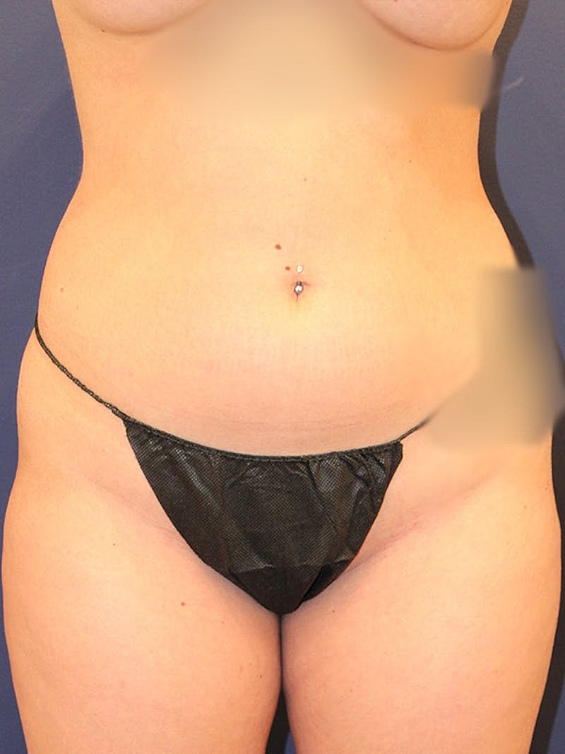 Liposuction Before & After