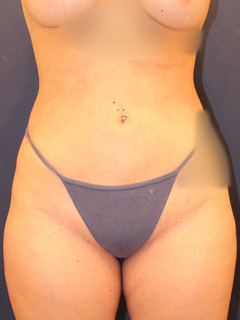 Liposuction Before & After