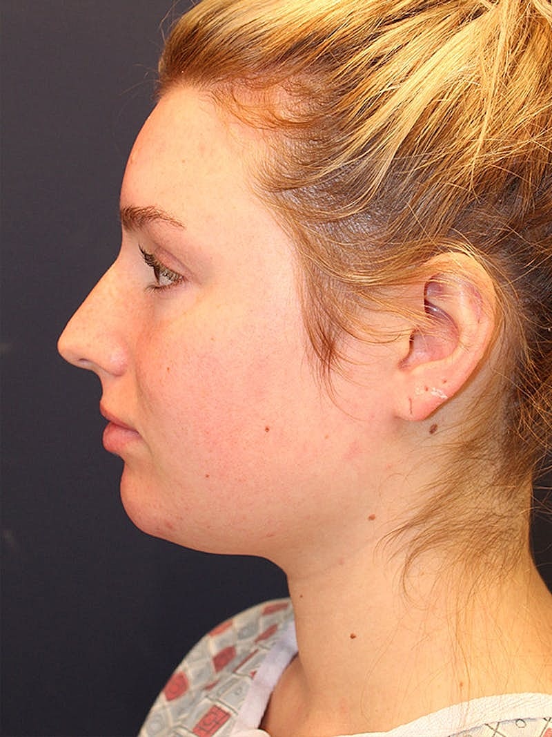 Liposuction Before & After