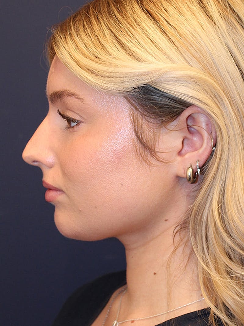 Liposuction Before & After