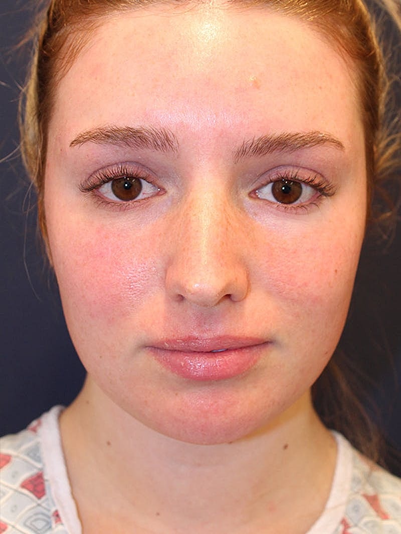 Liposuction Before & After