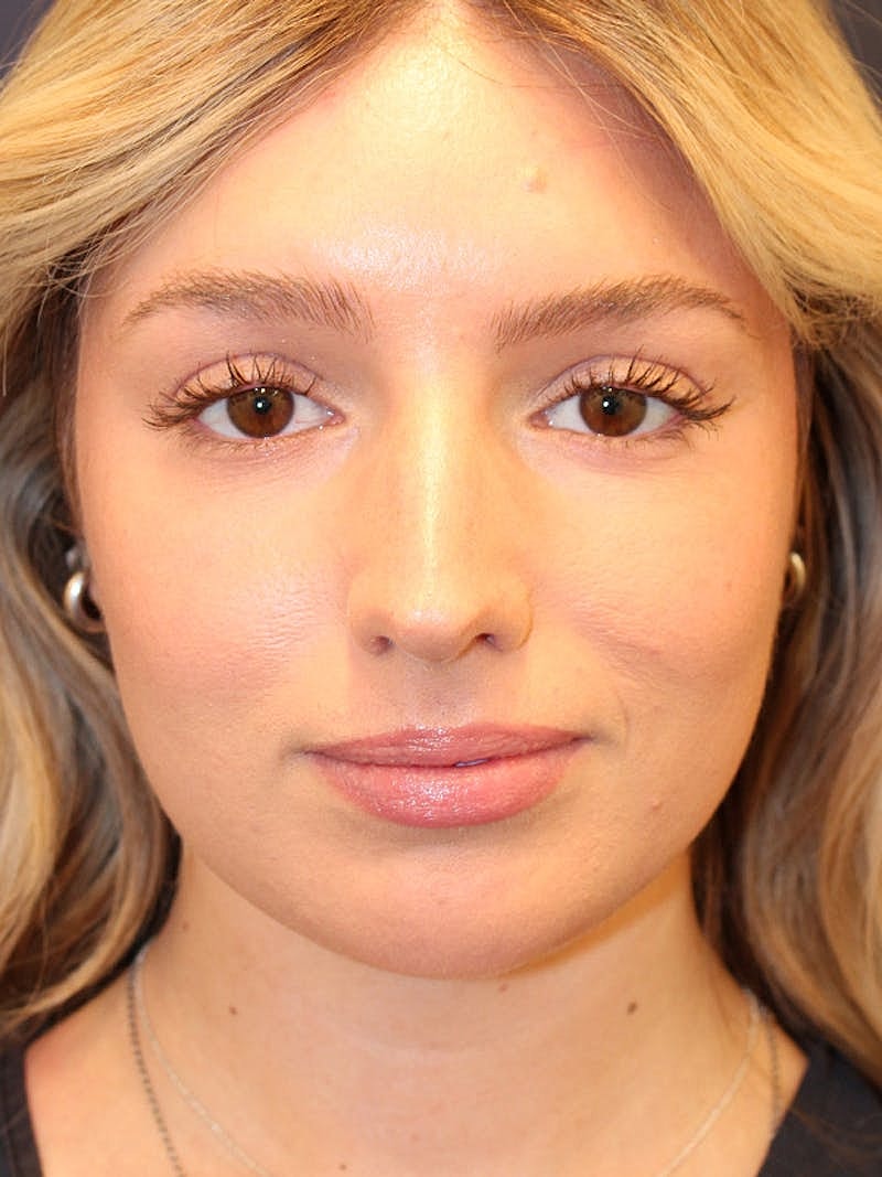 Liposuction Before & After