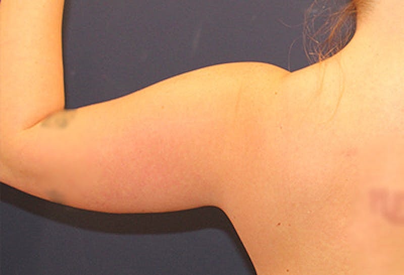 Liposuction Before & After