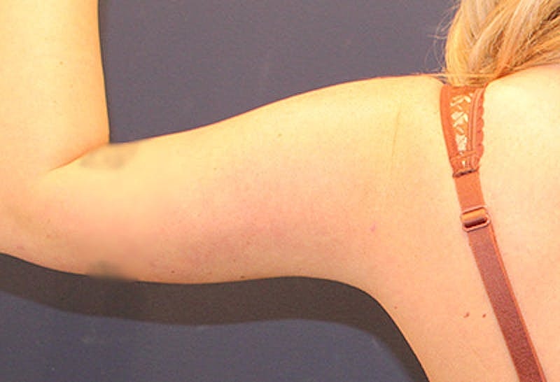 Liposuction Before & After