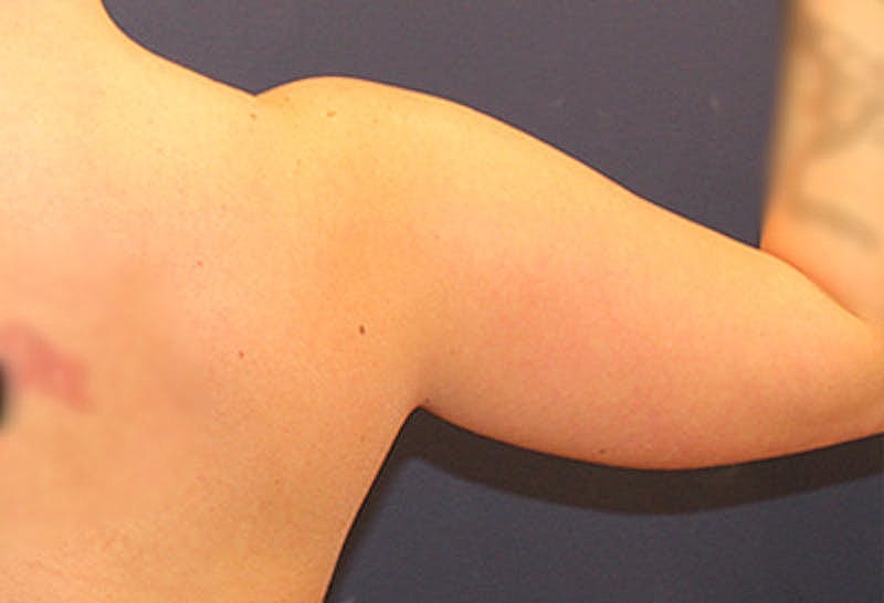 Liposuction Before & After