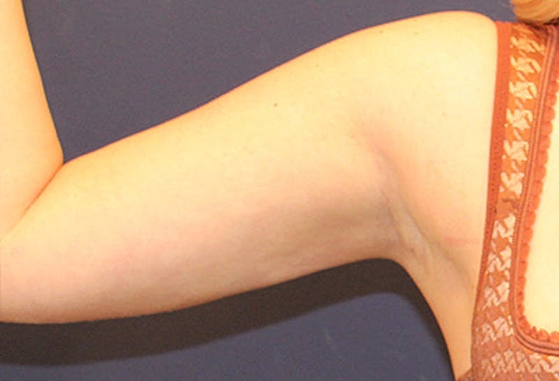 Liposuction Before & After