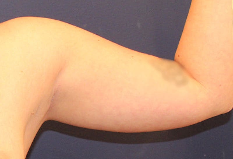 Liposuction Before & After