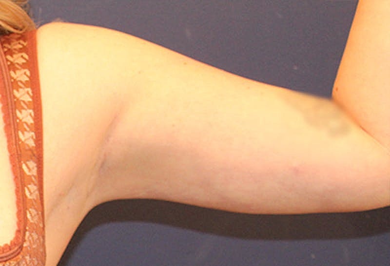 Liposuction Before & After