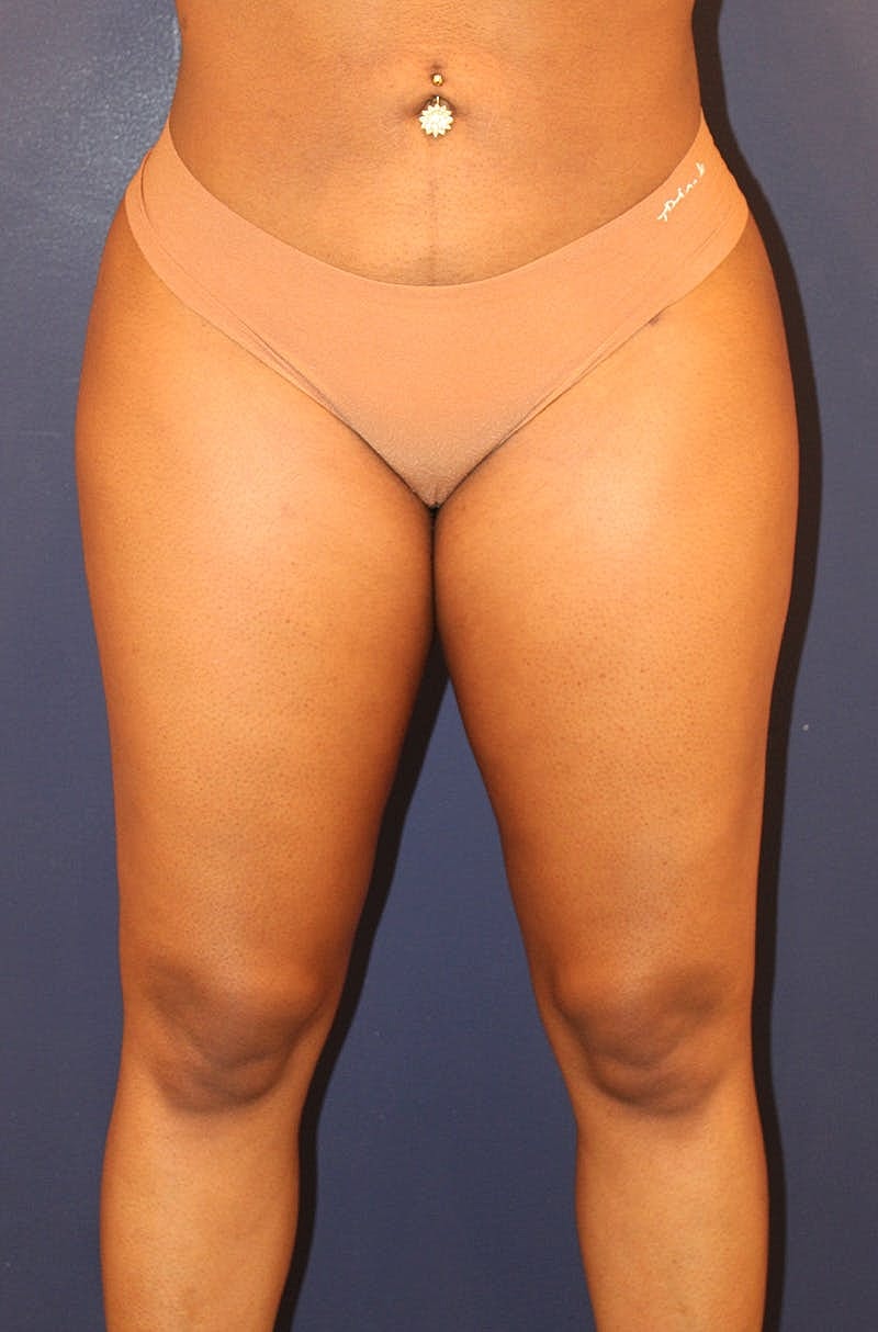 Liposuction Before & After
