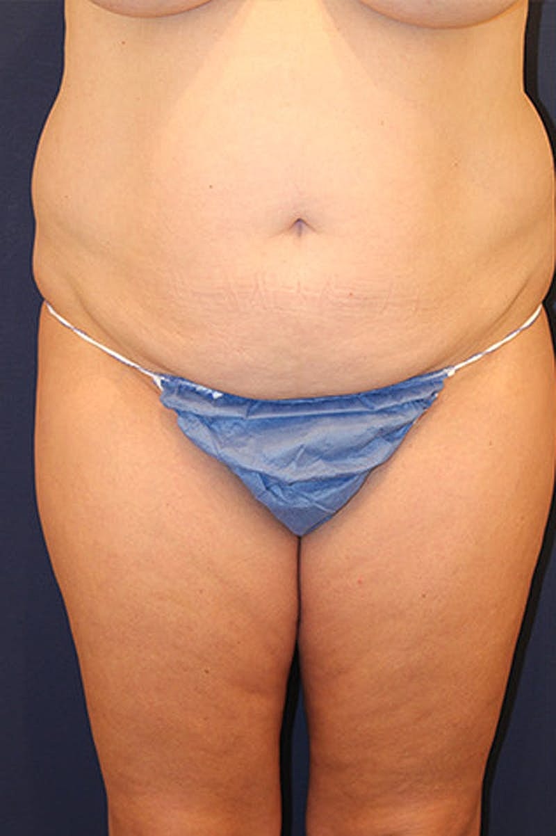 Liposuction Before & After